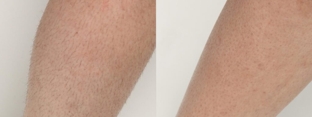 diolazexl-before-after-dr-j-diamond