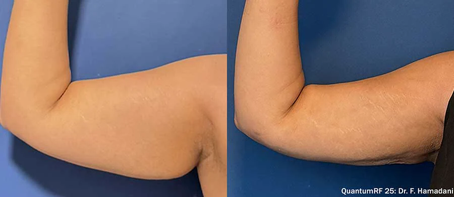 QuantumRF upper arm skin tightening before and after