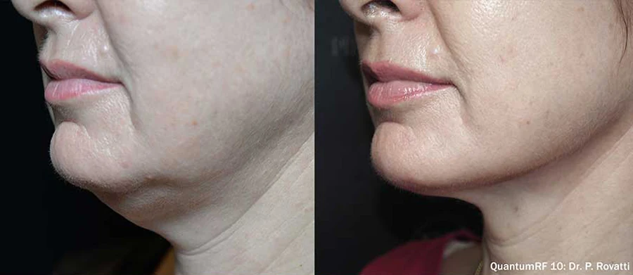 QuantumRF jowl and jawline tightening before and after
