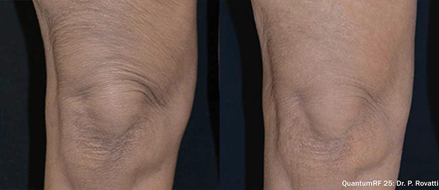 QuantumRF knee skin tightening before and after