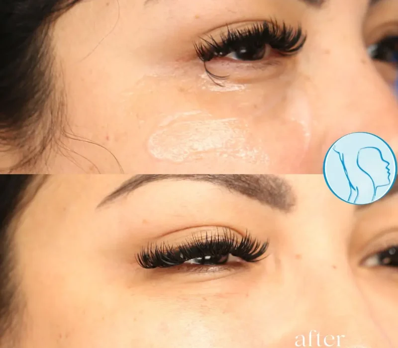 Undereye filler