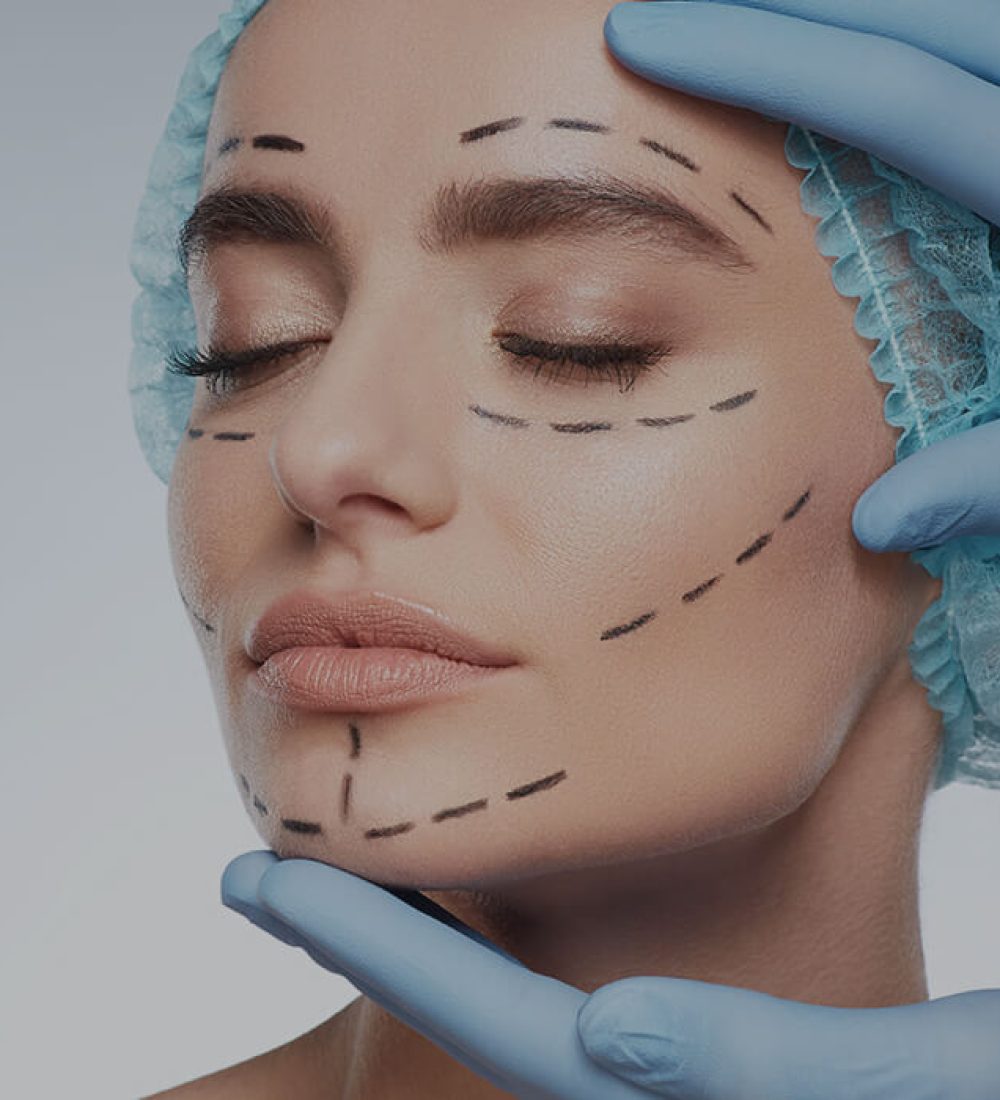 Thread lift Thread lift